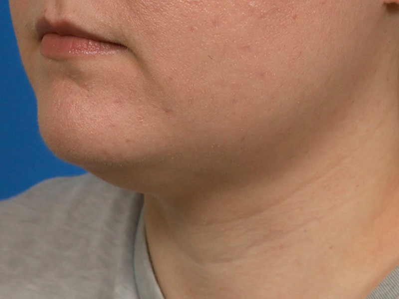 Neck Liposuction Before & After Image