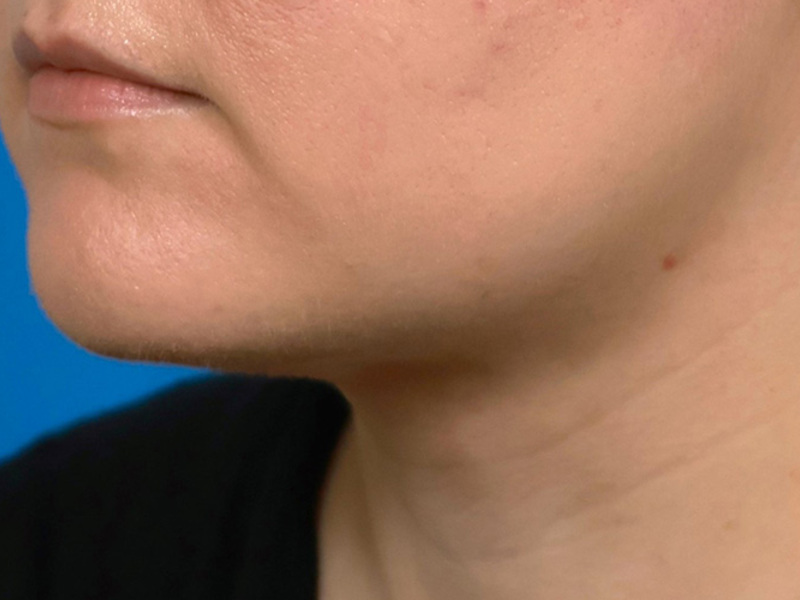 Neck Liposuction Before & After Image