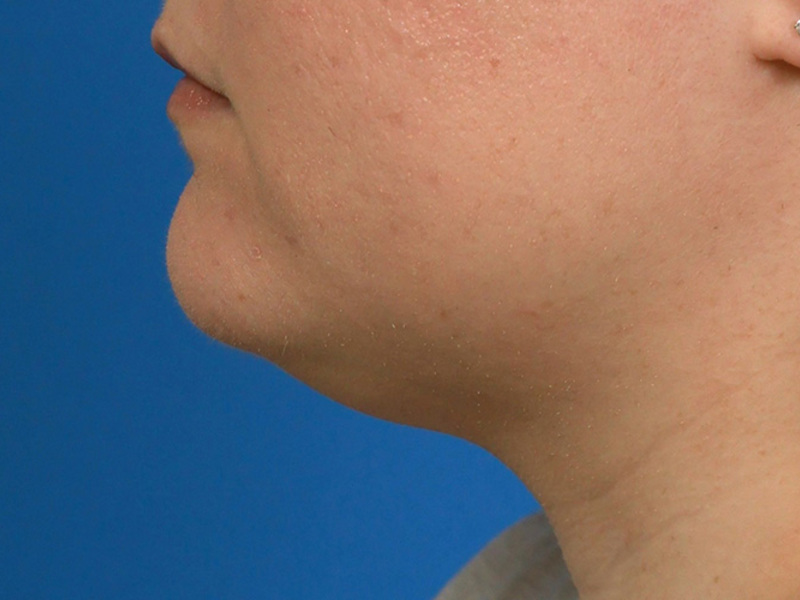 Neck Liposuction Before & After Image