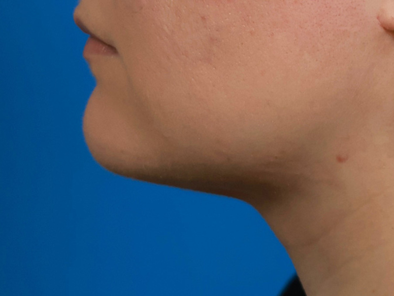 Neck Liposuction Before & After Image