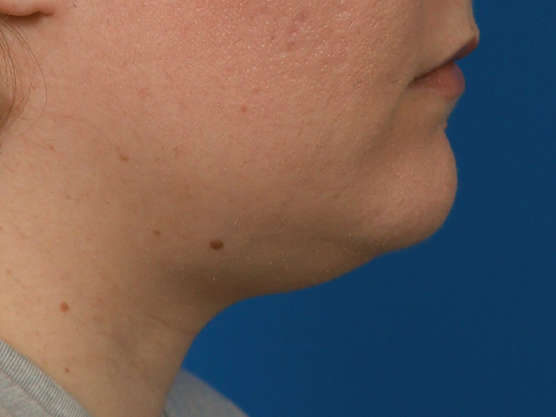 Neck Liposuction Before & After Image