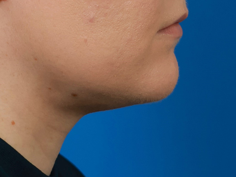 Neck Liposuction Before & After Image