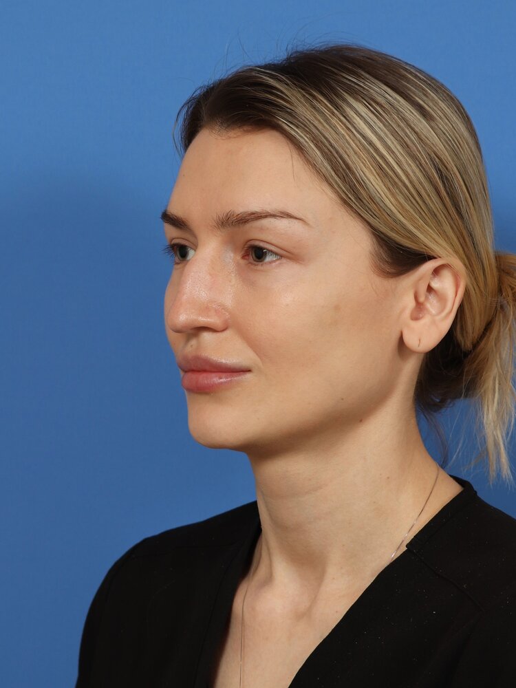 Rhinoplasty Before & After Image
