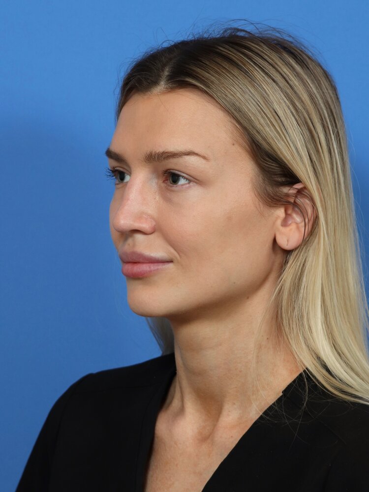 Rhinoplasty Before & After Image