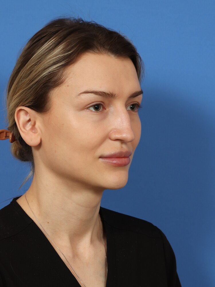 Rhinoplasty Before & After Image
