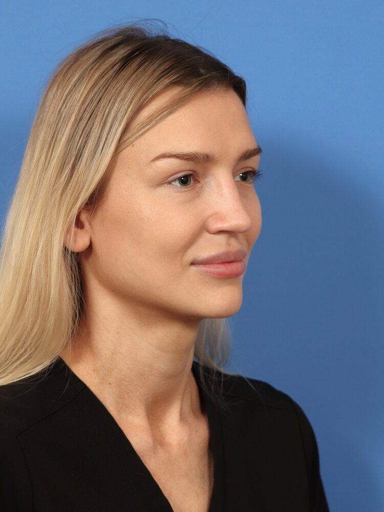 Rhinoplasty Before & After Image