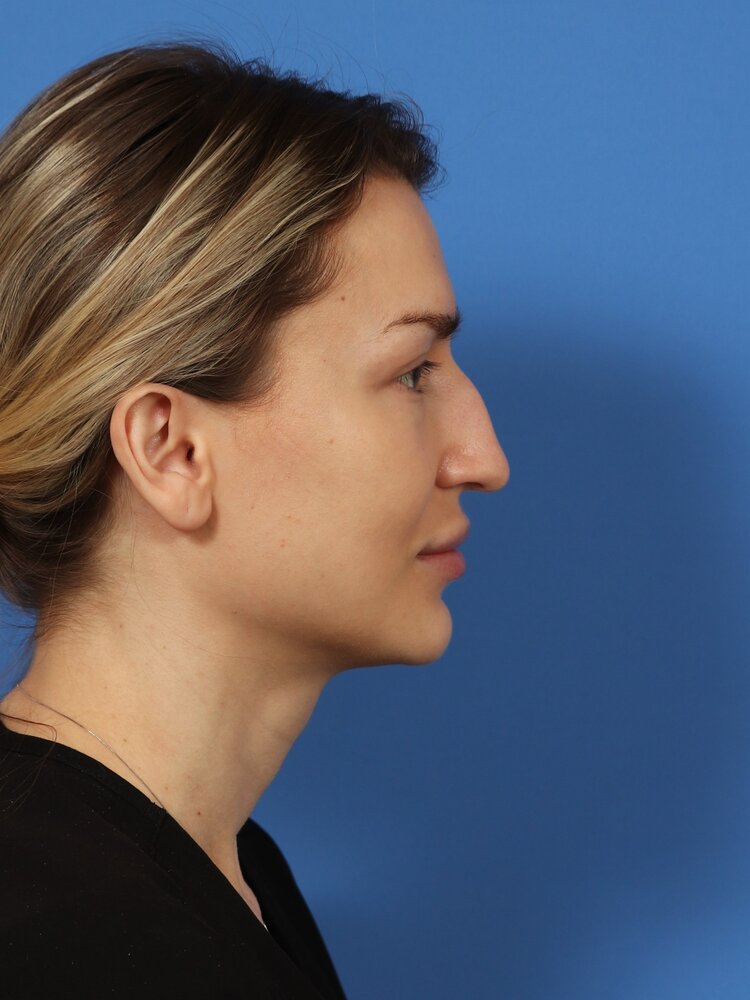Rhinoplasty Before & After Image