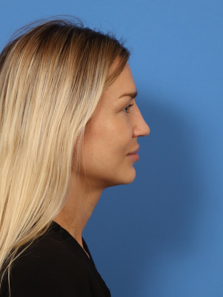 Rhinoplasty Before & After Image