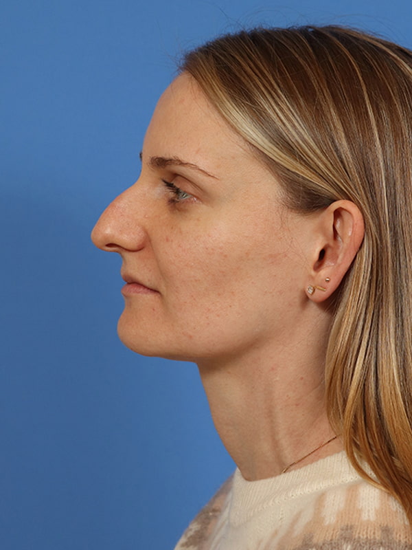 Rhinoplasty Before & After Image