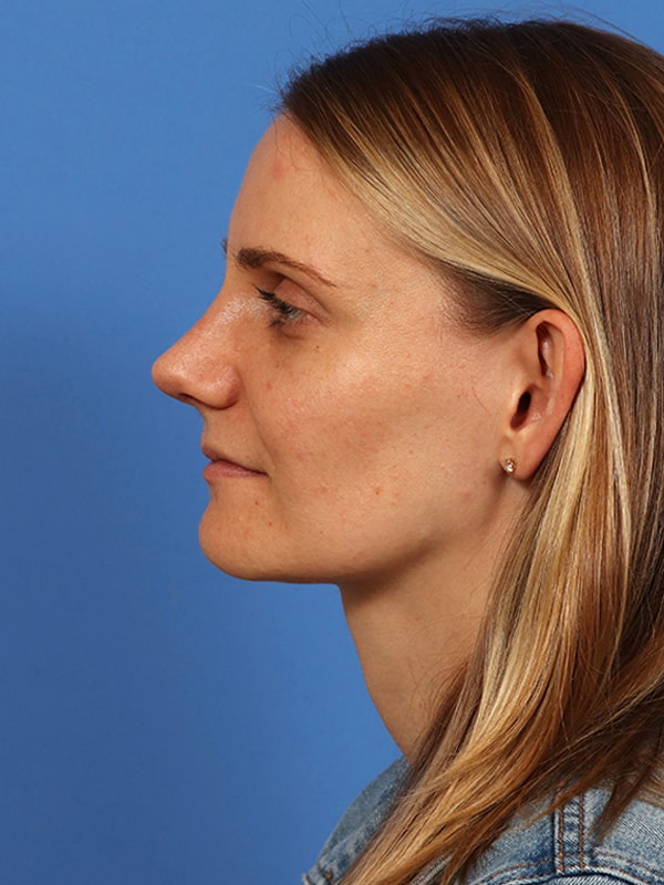 Rhinoplasty Before & After Image