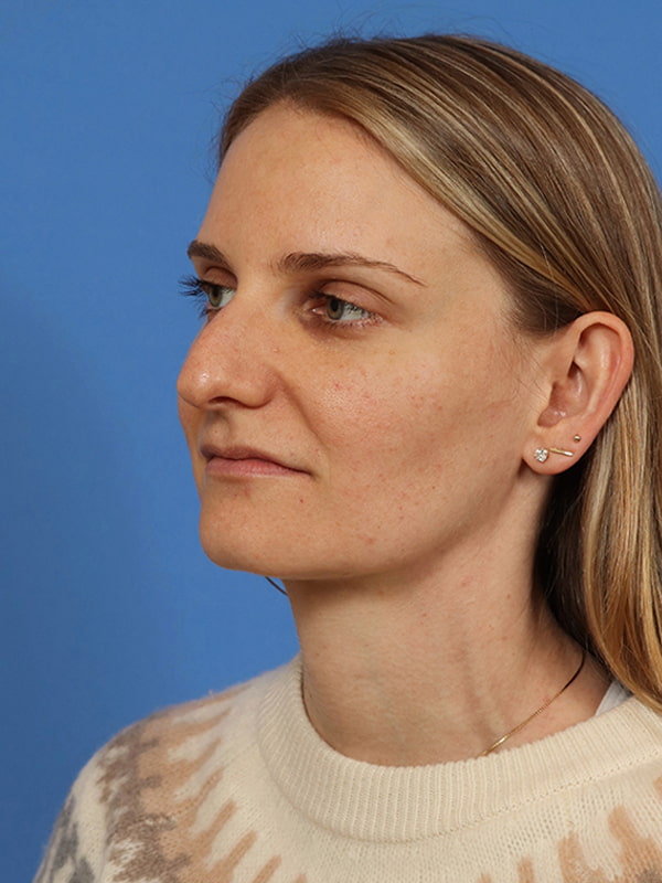 Rhinoplasty Before & After Image