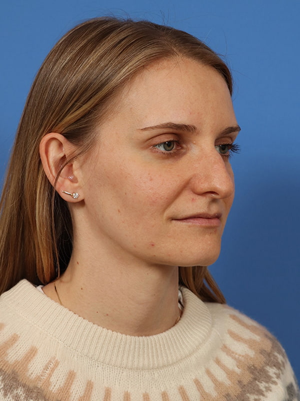 Rhinoplasty Before & After Image