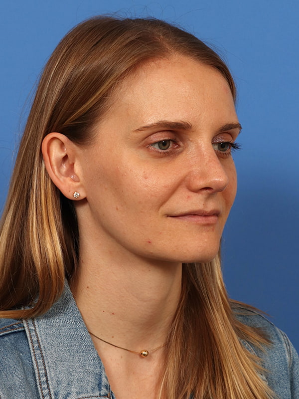 Rhinoplasty Before & After Image