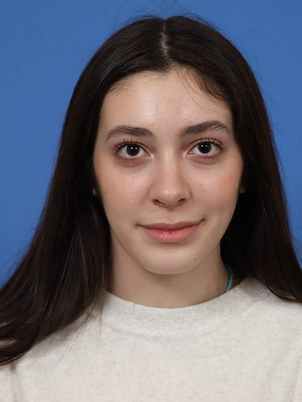 Rhinoplasty Before & After Image