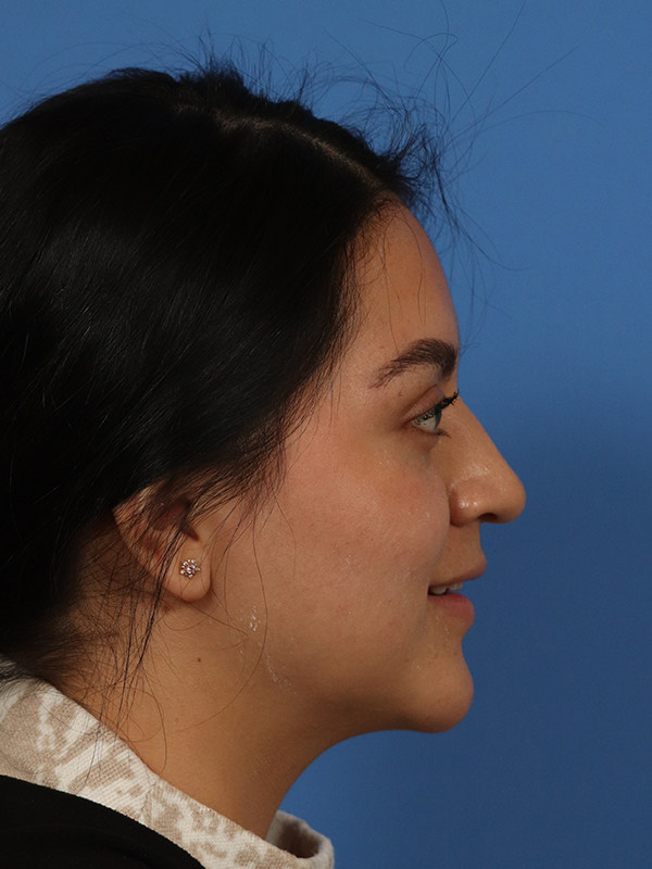 Rhinoplasty Before & After Image