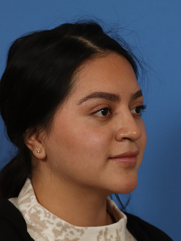 Rhinoplasty Before & After Image