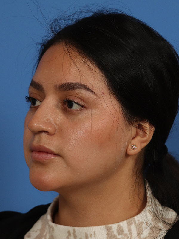 Rhinoplasty Before & After Image