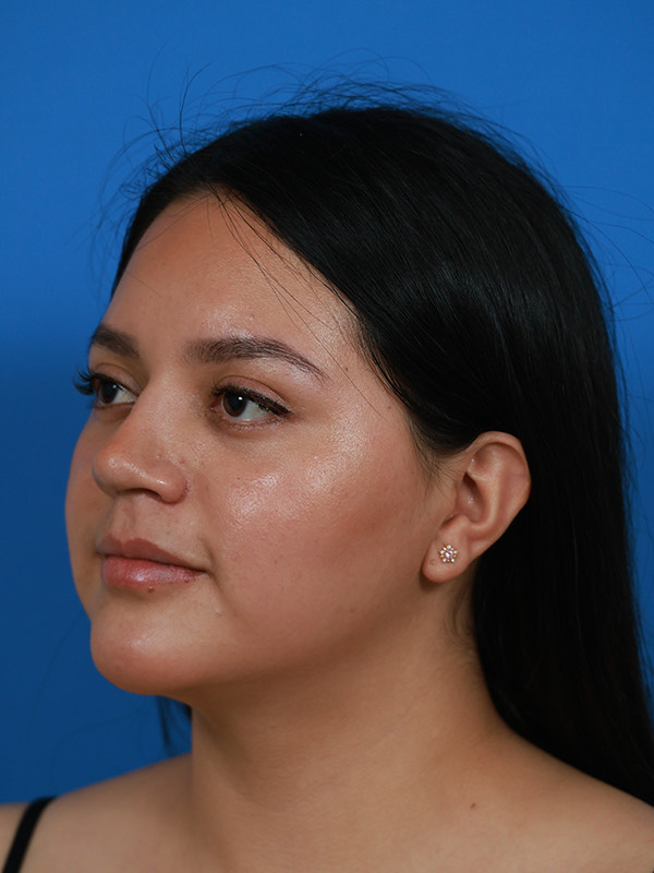 Rhinoplasty Before & After Image