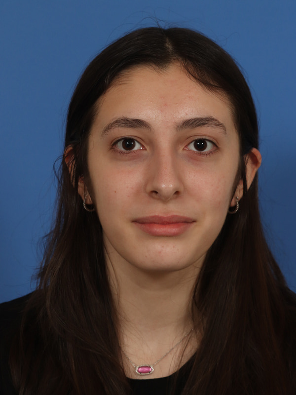 Rhinoplasty Before & After Image