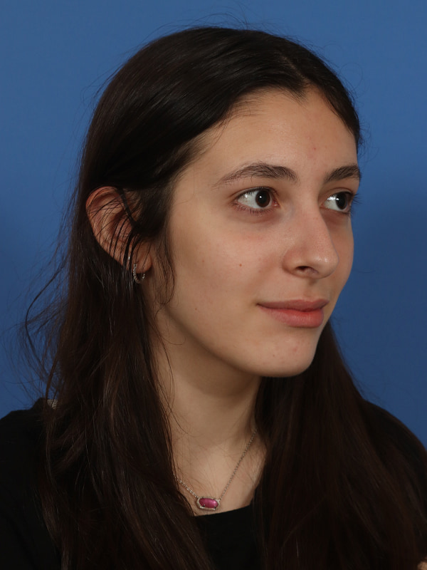 Rhinoplasty Before & After Image