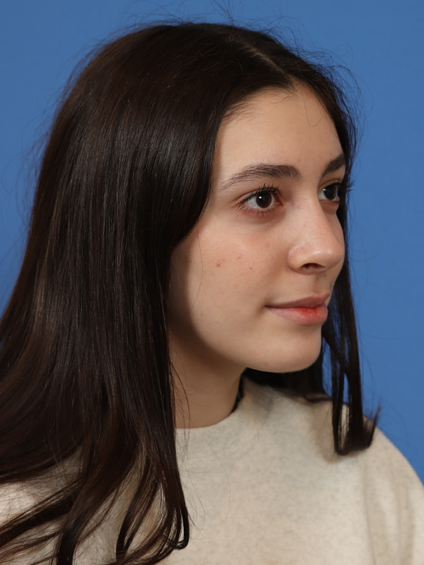 Rhinoplasty Before & After Image