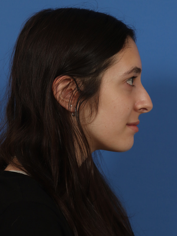 Rhinoplasty Before & After Image