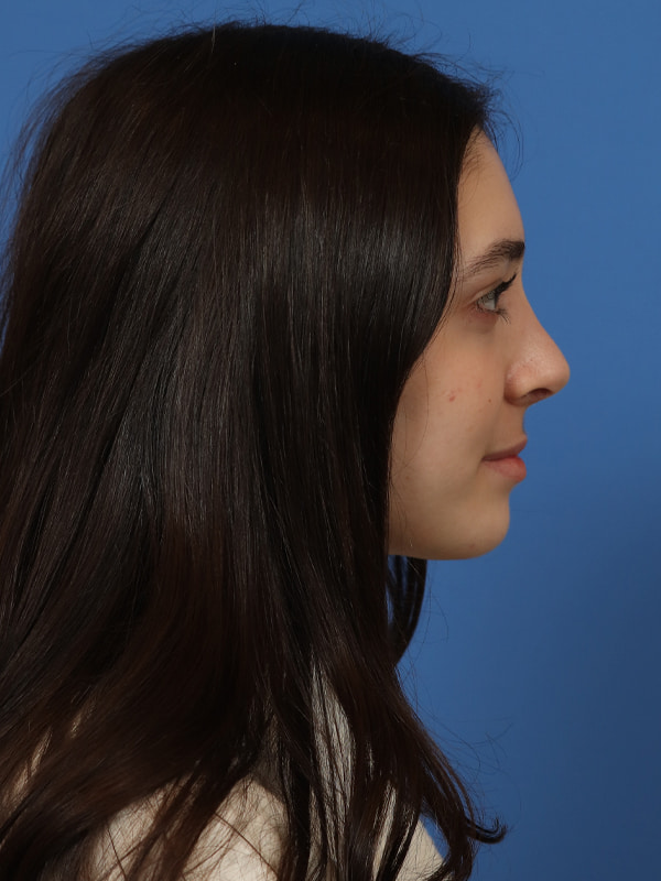 Rhinoplasty Before & After Image