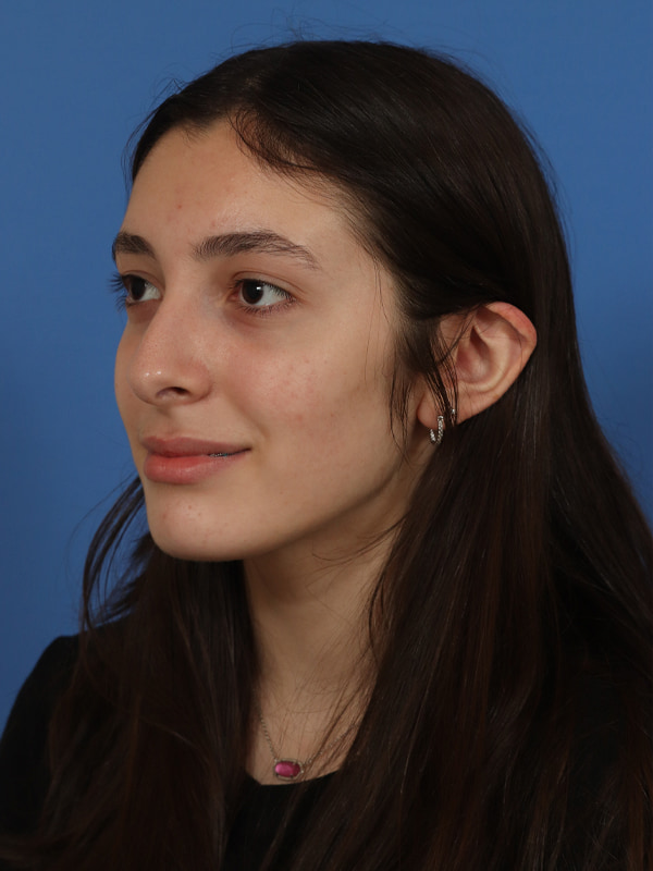 Rhinoplasty Before & After Image