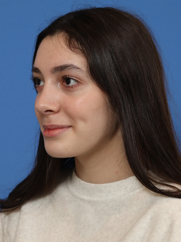 Rhinoplasty Before & After Image