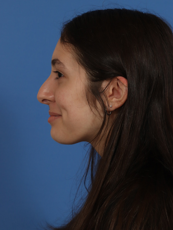 Rhinoplasty Before & After Image