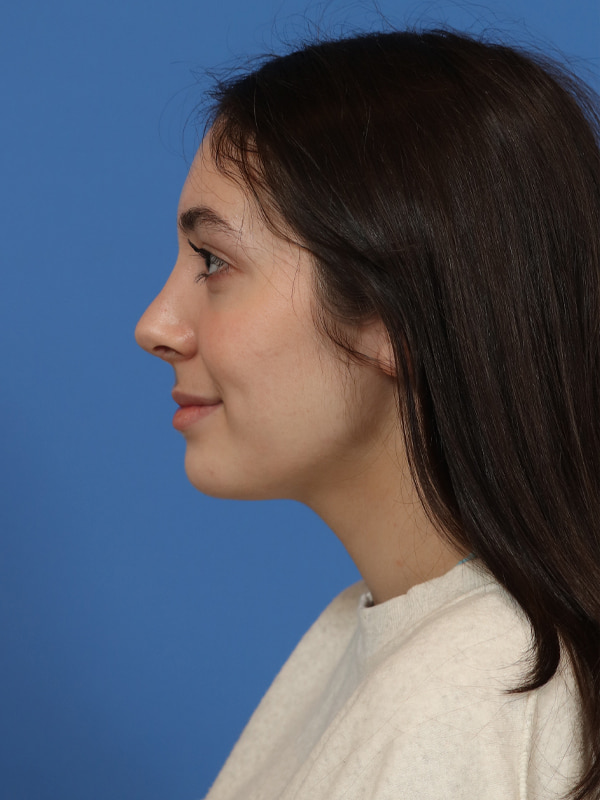 Rhinoplasty Before & After Image